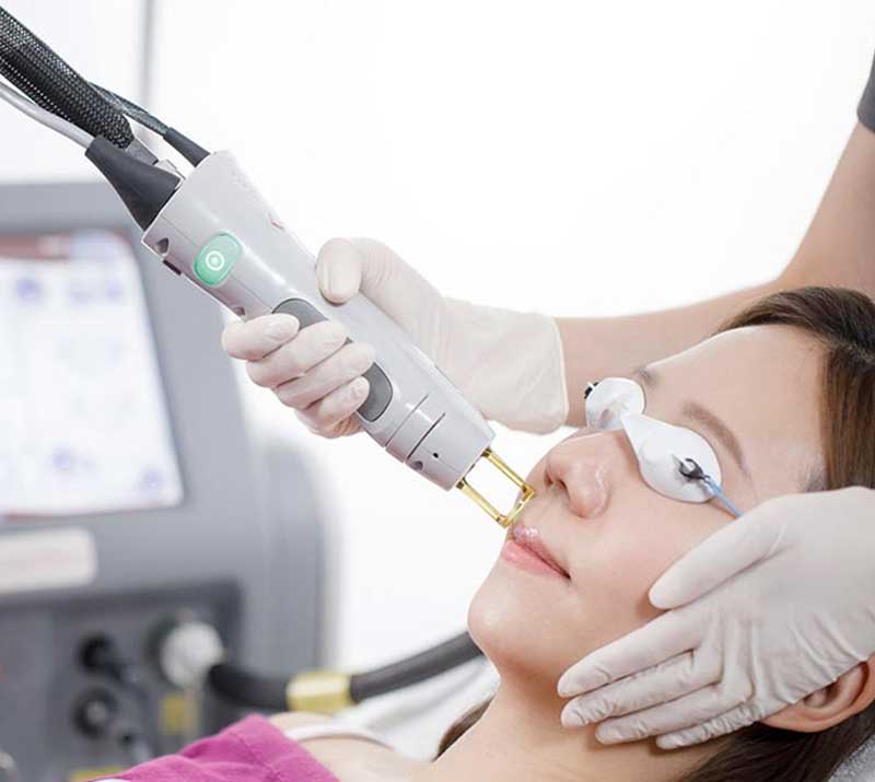 Merit Laser Services